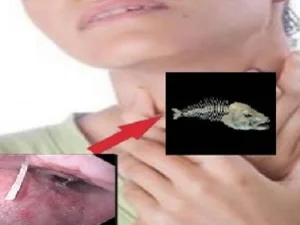 Bagaimana Cara Mengatasi Duri Ikan di Tenggorokan?