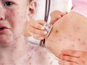Bahaya Virus Rubella Serang Wanita Hamil di Masa Pembentukan Janin