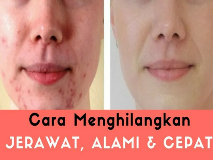 Tips Ampuh Menghilangkan Bekas Jerawat Secara Alami
