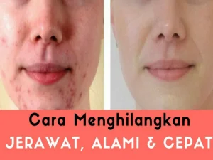 Tips Ampuh Menghilangkan Bekas Jerawat Secara Alami