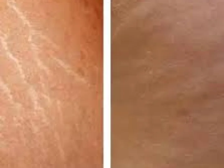 Cara Efektif untuk Menghilangkan Selulit