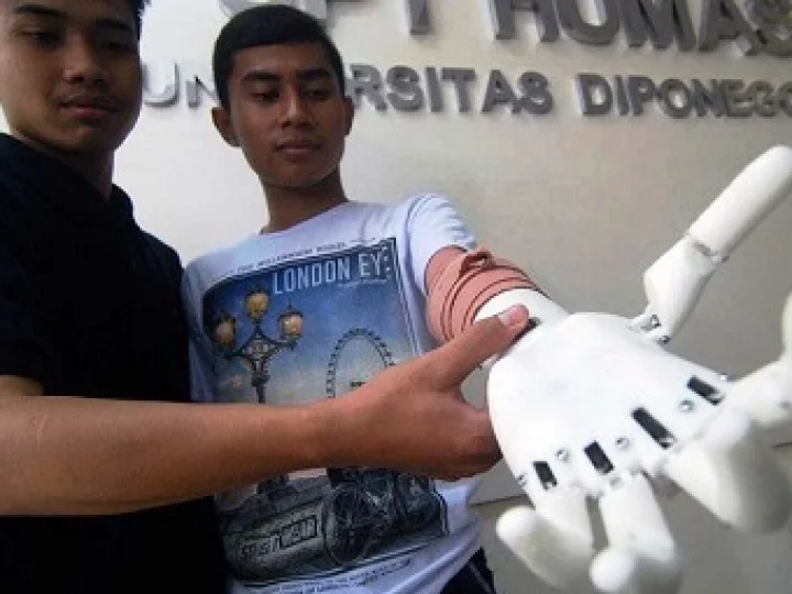 Undip Semarang Ciptakan Tangan Bionik untuk Difabel